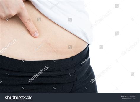 Image result for Appendix Surgery Scar