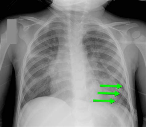 Rib fractures
