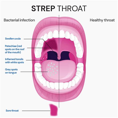 Strep Throat White Spots On Tonsils