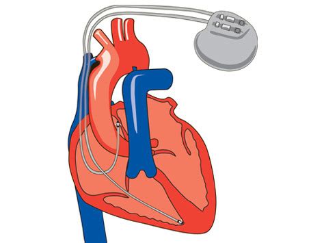 Pacemaker Procedure 的图像结果