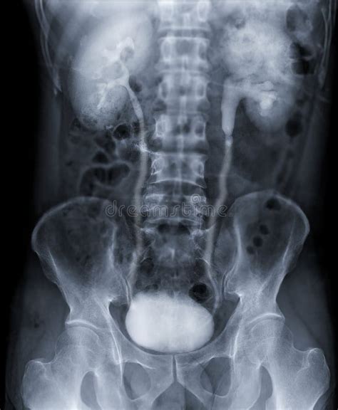 Image result for Contrast Pyelogram