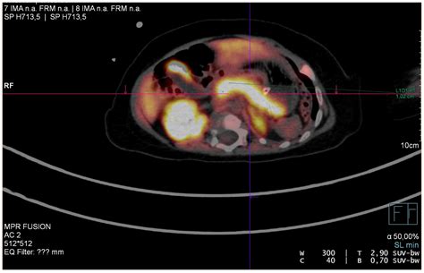 Congenital Hyperinsulinaemic Hypoglycaemia—A Review and Case Presentation
