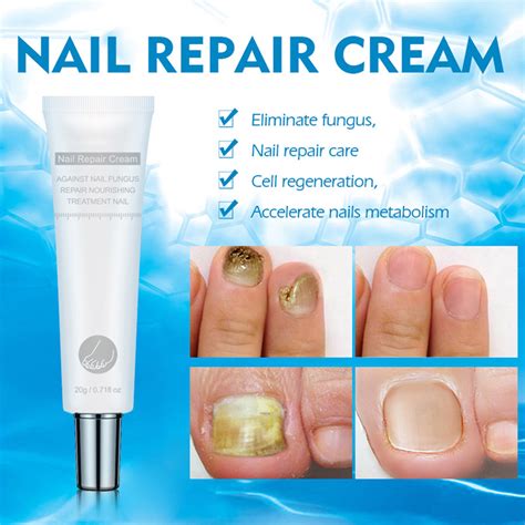 Fungus Nail Cream Anti Fungal Nail Cream 20g Fungus Nail Cream Nail ...