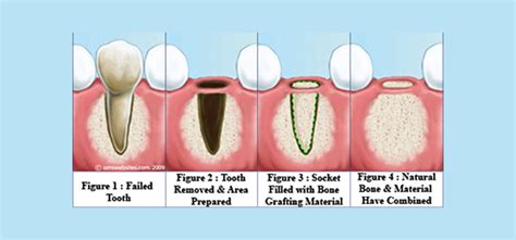 Bone Grafting Procedures in Surat - Dentist in Surat