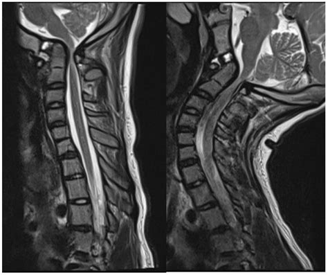 Patient-Specific 3D-Printed C1-C2 Interfacet Spacers for the Treatment ...