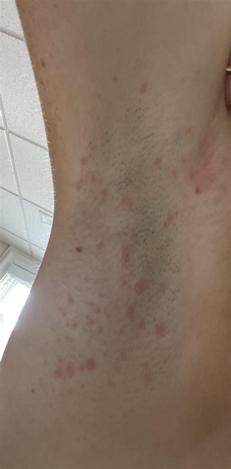 What is this itchy rash under both armpits? : r/Dermatology
