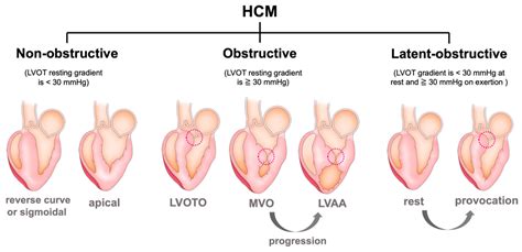 Contemporary Diagnosis and Management of Hypertrophic Cardiomyopathy ...