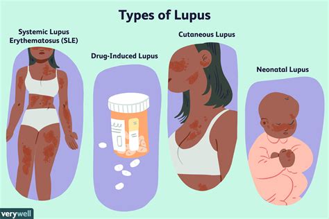 Lupus : Symptômes, Diagnostic Et Traitements – MFTIHF