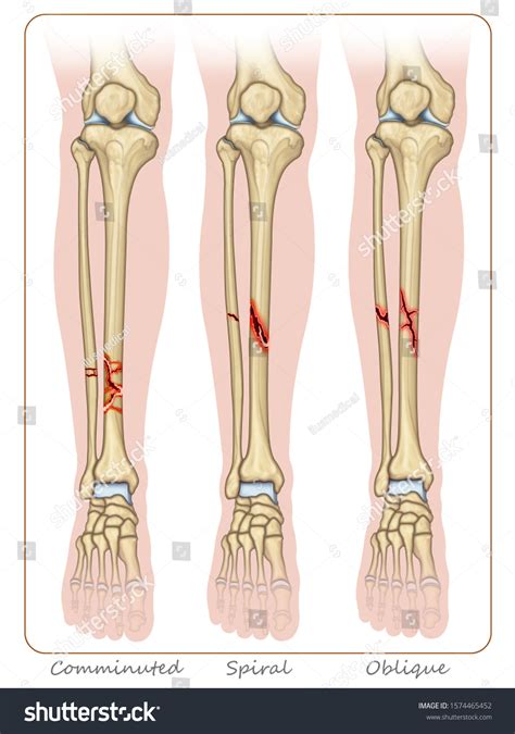 4,411 Open Fracture Images, Stock Photos & Vectors | Shutterstock