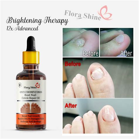 flora shine Nail Fungus Treatment Repair Foot Removal Toe Fungal ...