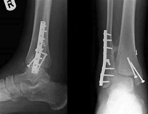 Tibiofibular Synostosis following Syndesmosis Fixation: A case report ...