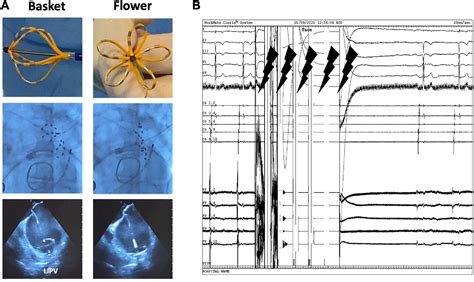 Frontiers | Initial experience with pulsed field ablation for atrial ...