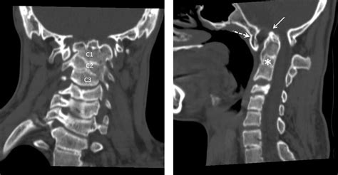 Klippel Feil Syndrome Radiology Klippel Feil Anomaly | Spot Diagnosis