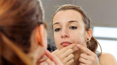 Is Acne Genetically Inherited?: Doctor's Guide | Clinikally