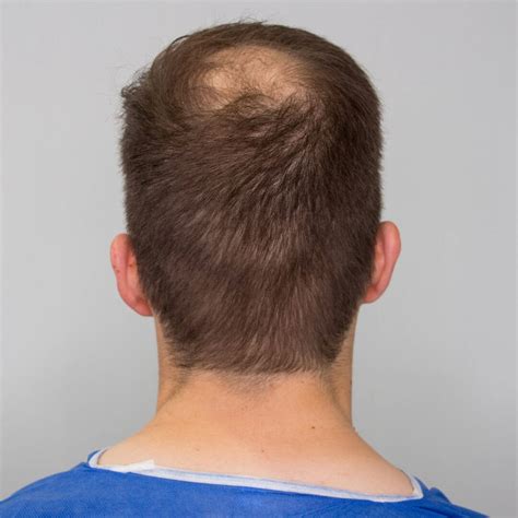 What will the back of your head look like after hair transplant surgery ...
