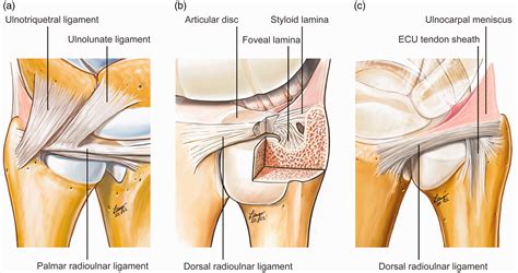Tri Fibrocartilage Tear