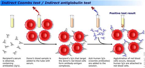 Image result for Coombs Test Positive vs Negative
