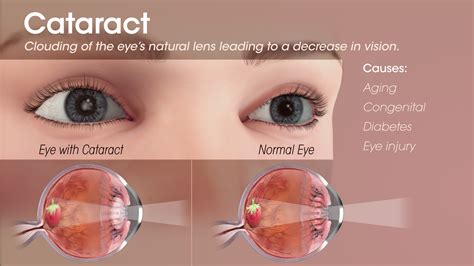 Cataract Symptoms What Age at William Stork blog