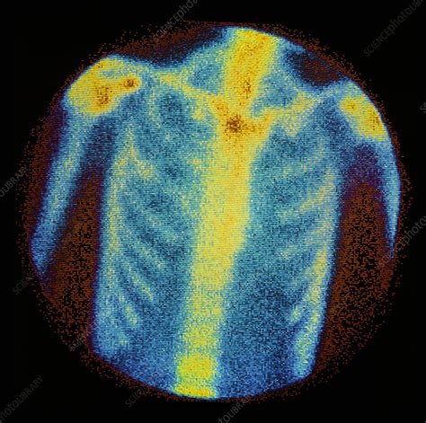 Image result for Normal Bone Scan