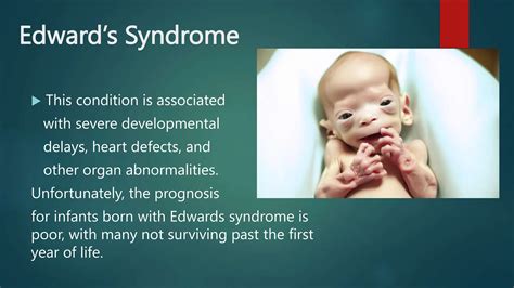 Edwards-Syndrome trisomy 18 presentation | PPTX