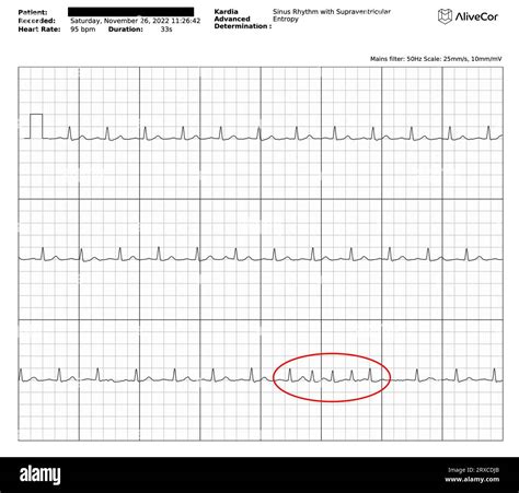 Junctional Bradycardia Rhythm Strip
