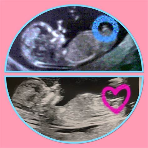 Its A Boy Ultrasound 12 Weeks Nub Theory? 12 Week Ultrasound. I Am