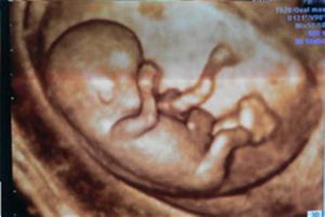 十月怀胎第几周最危险？胎儿畸形最容易发生在这周，孕妈们要注意__凤凰网