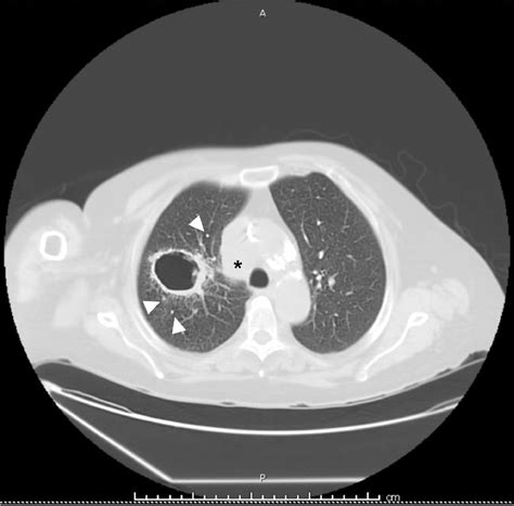 Consider the ‘Hole’ Differential: Pulmonary Malignancy Presenting as a Cavitary Lesion - The ...