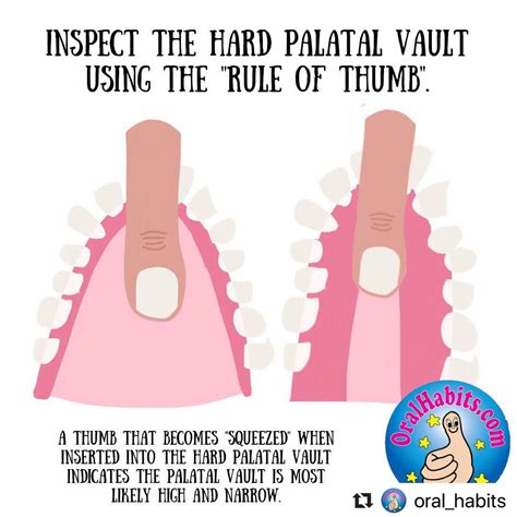 What Causes A High Palate at Joe Jennings blog