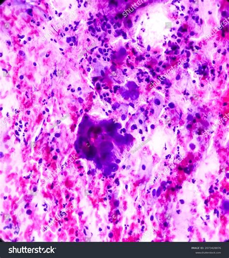 Atypical Squamous Cells Cervix