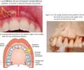 Infiltration Anesthesia Dental Lower 的图像结果