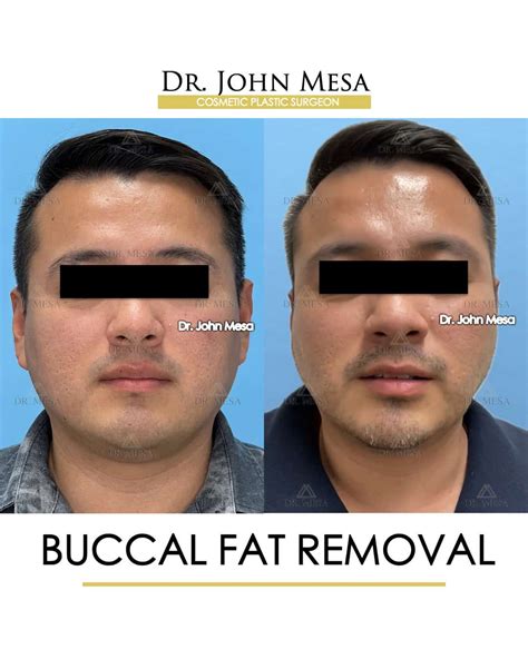 🥇 Buccal Fat Removal For Men NYC, New Jersey, and Miami