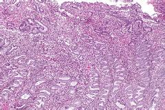 Image result for Disordered Proliferative Endometrium