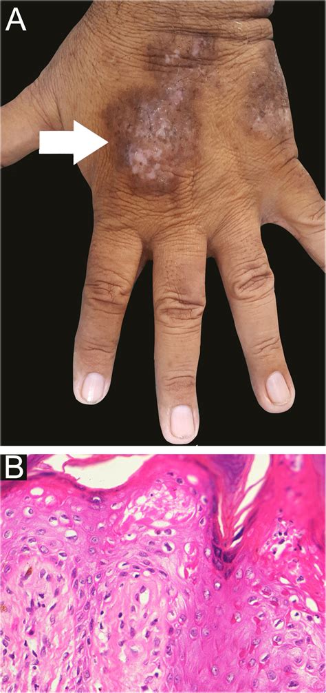 Treatment of lichen planus pemphigoides with mesalamine: novel use of this drug | Anais ...