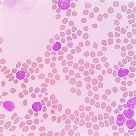 Red Blood Cell Morphology Echinocytes Schistocytes – A Laboratory