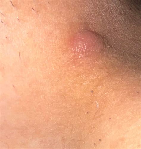 ? lump near groin/inner thigh area : r/medical_advice