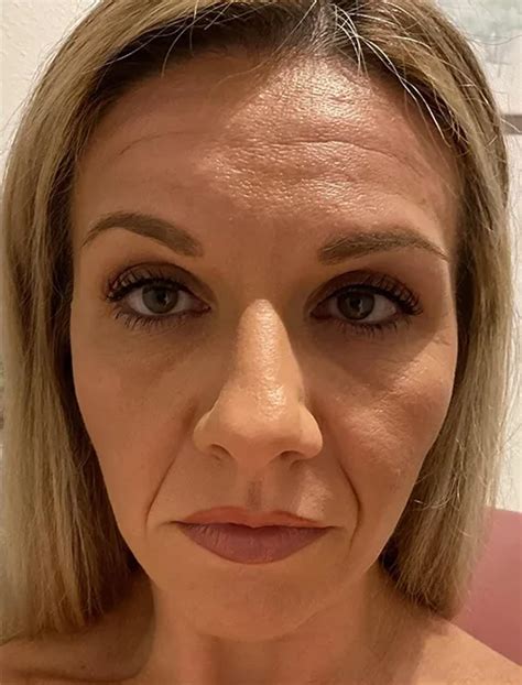 Image result for Botox Examples