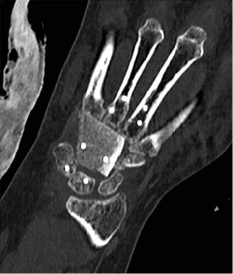 Carpal giant cell tumour