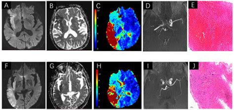 Diagnosis and Management of Acute Ischemic Stroke