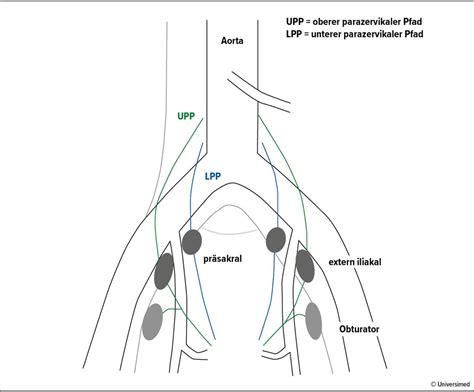 Das operative Management beim Endometriumkarzinom - Onkologie ...