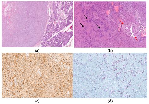 Unmasking Hypoglossal Nerve Schwannomas Mimicking Submandibular ...