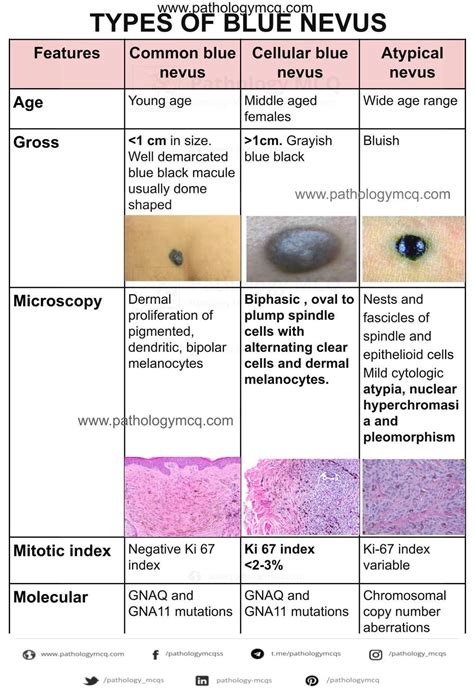 Blue Nevus Vs Melanoma Benign Pigmented Lesions And Malignant Melanoma