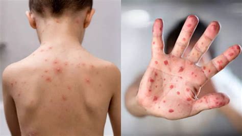 Chickenpox Signs And Symptoms: Can You Get Chickenpox As An Adult? Know ...
