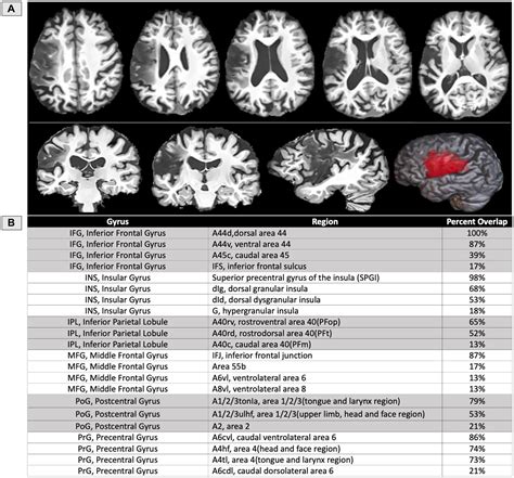 Verbal Apraxia Example 的图像结果