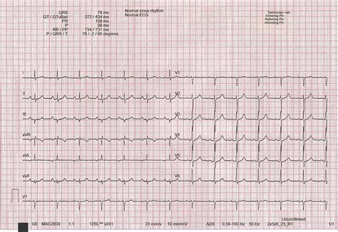 Normal ECG Read Out 的图像结果