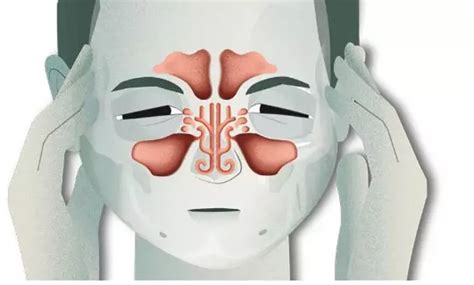 Low dose Azithromycin effective in refractory chronic rhinosinusitis: Study