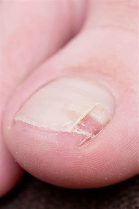 How to Fix Split Nails 的图像结果