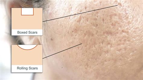 Acne Scar Types: Icepick, Rolling, Boxcar, Hypertrophic/Keloid