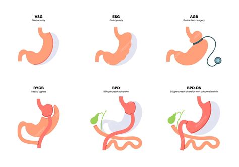 Premium Vector | Types of bariatric surgery healthy stomach and internal organs after operation ...