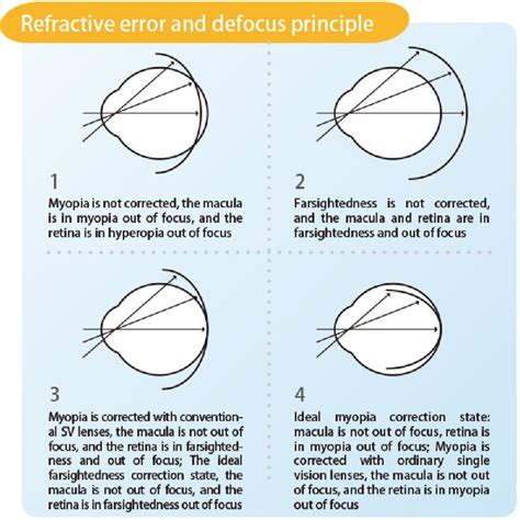 Myopia Control Lens